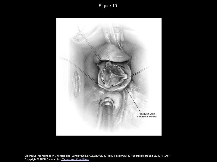 Figure 10 Operative Techniques in Thoracic and Cardiovascular Surgery 2010 15321 -335 DOI: (10.