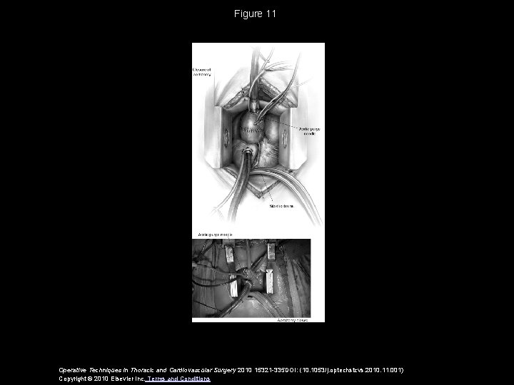 Figure 11 Operative Techniques in Thoracic and Cardiovascular Surgery 2010 15321 -335 DOI: (10.