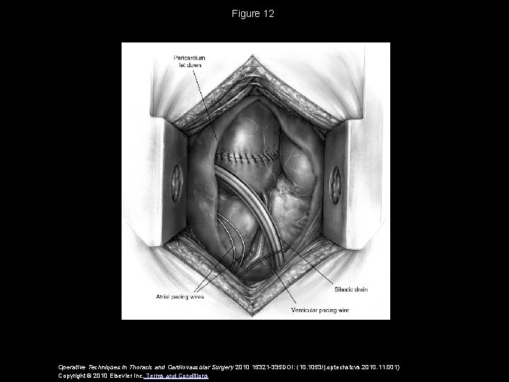 Figure 12 Operative Techniques in Thoracic and Cardiovascular Surgery 2010 15321 -335 DOI: (10.