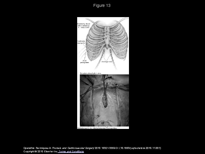Figure 13 Operative Techniques in Thoracic and Cardiovascular Surgery 2010 15321 -335 DOI: (10.