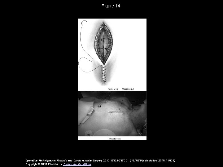 Figure 14 Operative Techniques in Thoracic and Cardiovascular Surgery 2010 15321 -335 DOI: (10.