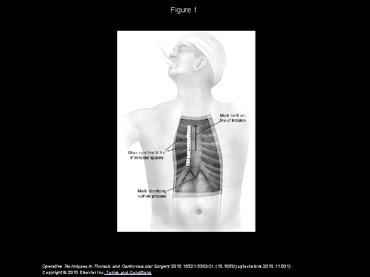 Figure 1 Operative Techniques in Thoracic and Cardiovascular Surgery 2010 15321 -335 DOI: (10.