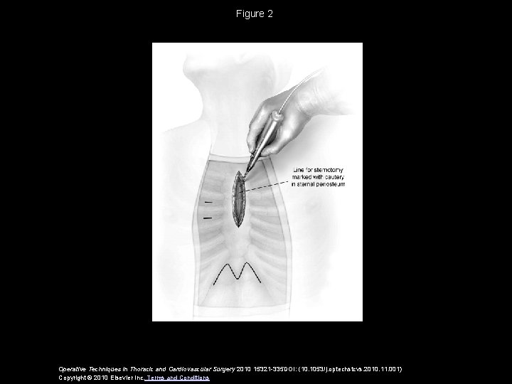 Figure 2 Operative Techniques in Thoracic and Cardiovascular Surgery 2010 15321 -335 DOI: (10.