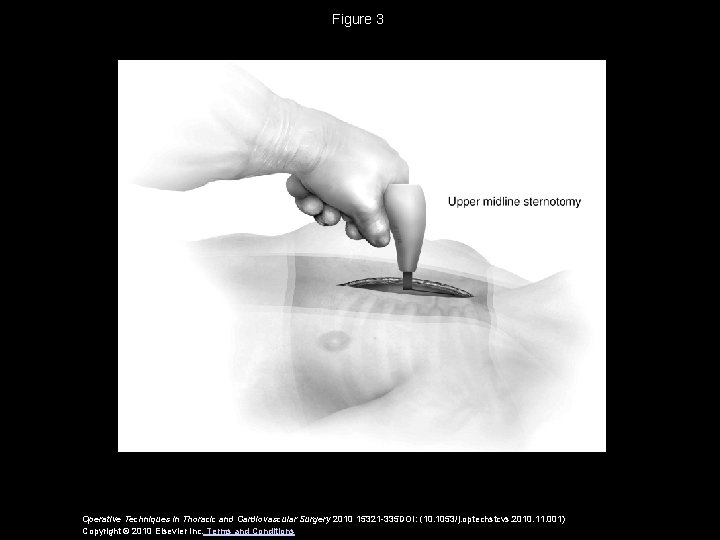 Figure 3 Operative Techniques in Thoracic and Cardiovascular Surgery 2010 15321 -335 DOI: (10.