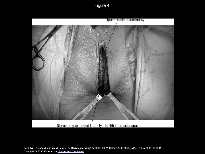 Figure 4 Operative Techniques in Thoracic and Cardiovascular Surgery 2010 15321 -335 DOI: (10.