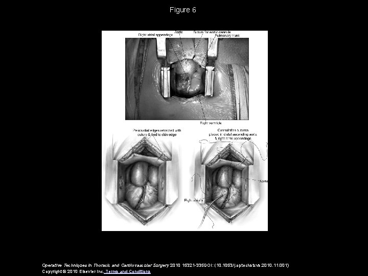 Figure 6 Operative Techniques in Thoracic and Cardiovascular Surgery 2010 15321 -335 DOI: (10.