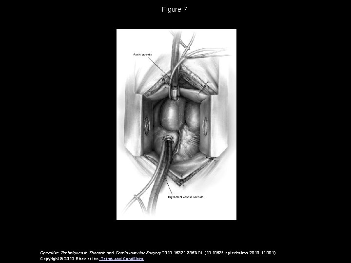 Figure 7 Operative Techniques in Thoracic and Cardiovascular Surgery 2010 15321 -335 DOI: (10.