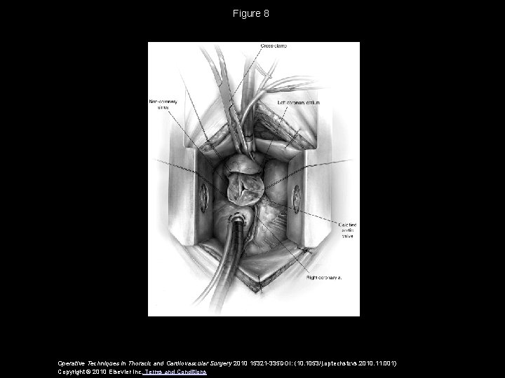 Figure 8 Operative Techniques in Thoracic and Cardiovascular Surgery 2010 15321 -335 DOI: (10.