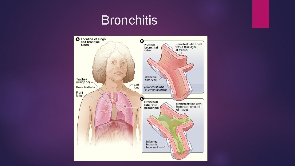 Bronchitis 