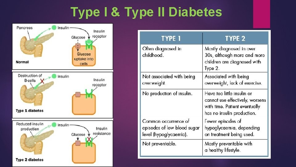 Type I & Type II Diabetes 