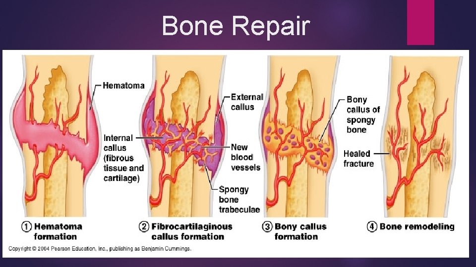 Bone Repair 