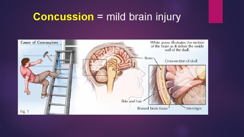 Concussion = mild brain injury 