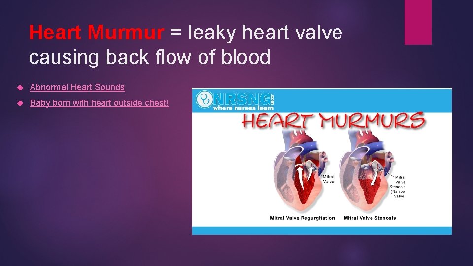 Heart Murmur = leaky heart valve causing back flow of blood Abnormal Heart Sounds