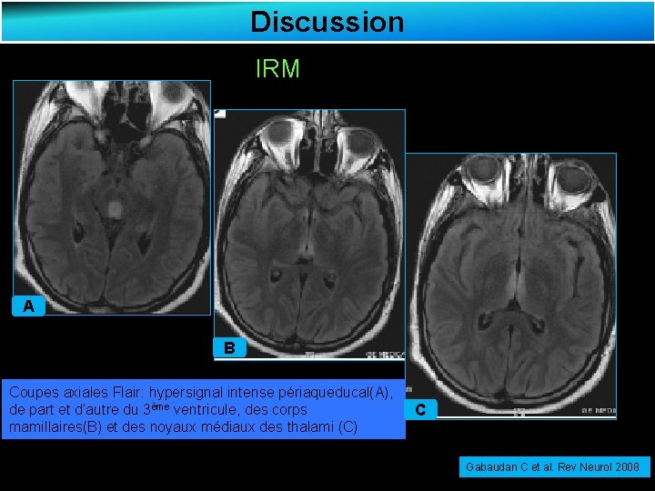 Discussion IRM A B Coupes axiales Flair: hypersignal intense périaqueducal(A), de part et d’autre