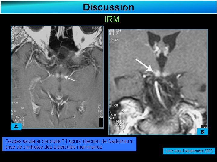 Discussion IRM A Coupes axiale et coronale T 1 après injection de Gadolinium: prise