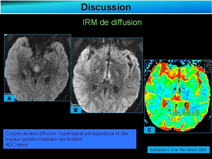 Discussion IRM de diffusion A B Coupes axiales diffusion: hypersignal périaqueducal et des noyaux