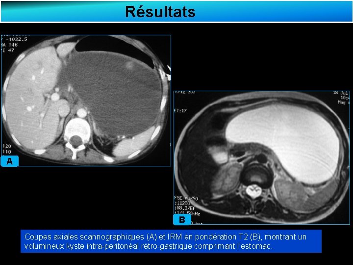 Résultats A B Coupes axiales scannographiques (A) et IRM en pondération T 2 (B),
