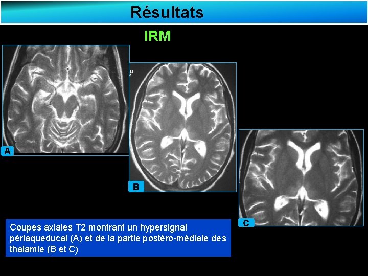 Résultats IRM A B Coupes axiales T 2 montrant un hypersignal périaqueducal (A) et