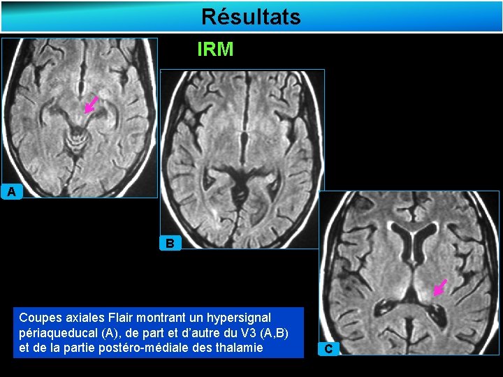 Résultats IRM A B Coupes axiales Flair montrant un hypersignal périaqueducal (A), de part