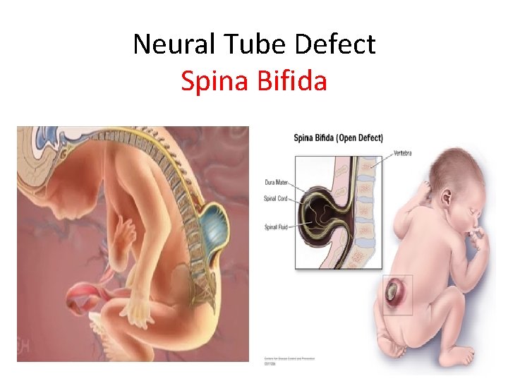 Neural Tube Defect Spina Bifida 