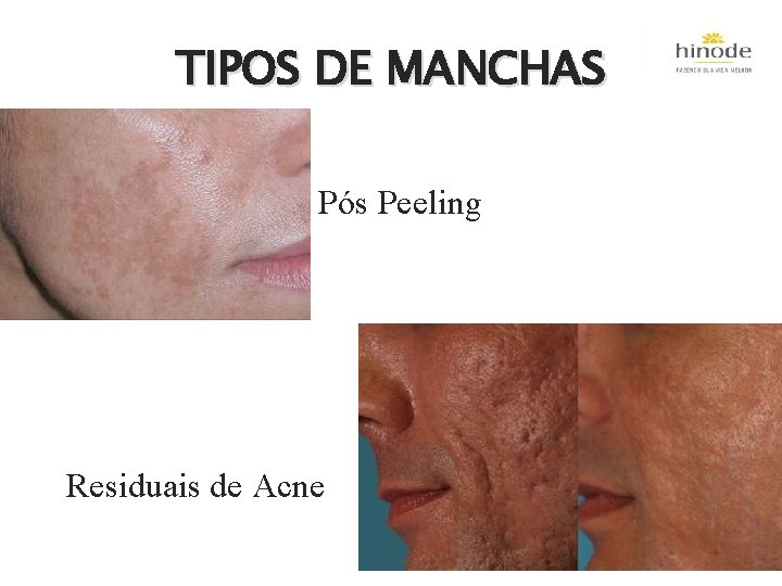 TIPOS DE MANCHAS Pós Peeling Residuais de Acne 