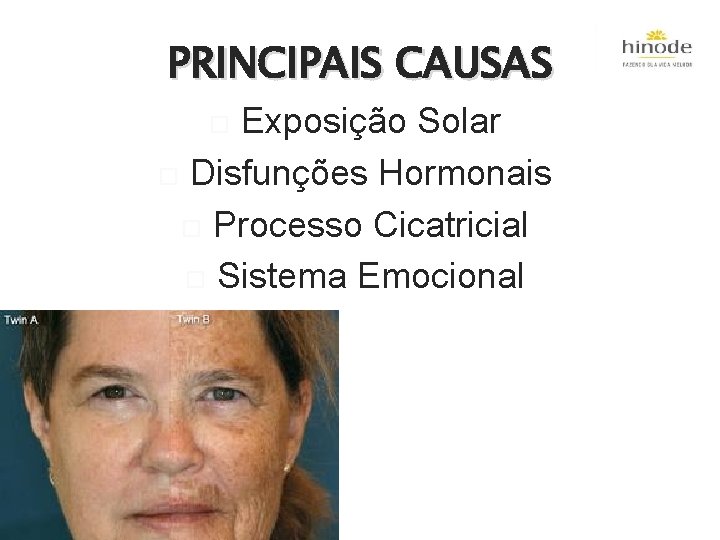 PRINCIPAIS CAUSAS Exposição Solar Disfunções Hormonais Processo Cicatricial Sistema Emocional 
