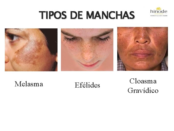 TIPOS DE MANCHAS Melasma Efélides Cloasma Gravídico 