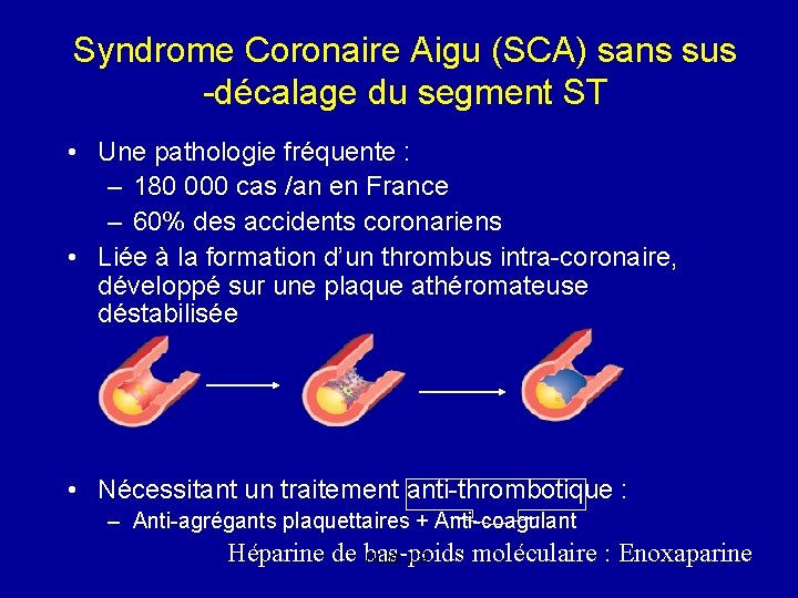 Syndrome Coronaire Aigu (SCA) sans sus -décalage du segment ST • Une pathologie fréquente