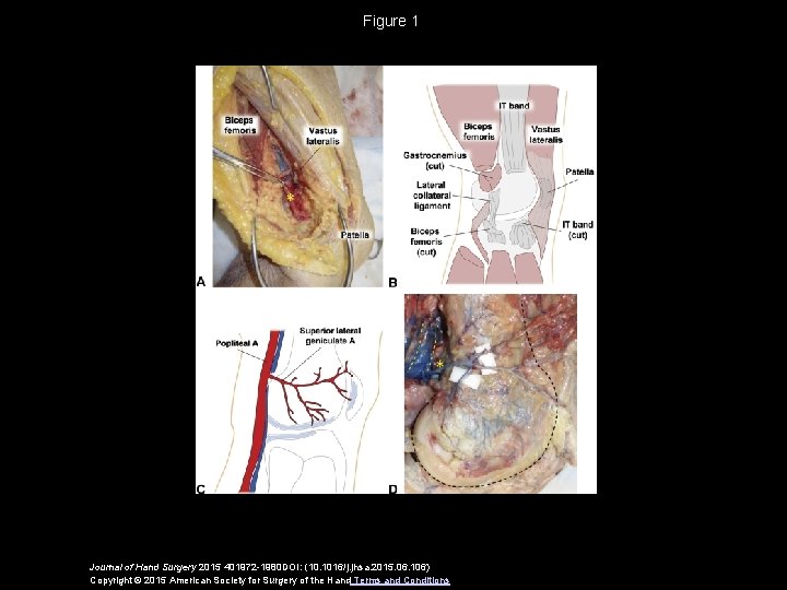 Figure 1 Journal of Hand Surgery 2015 401972 -1980 DOI: (10. 1016/j. jhsa. 2015.