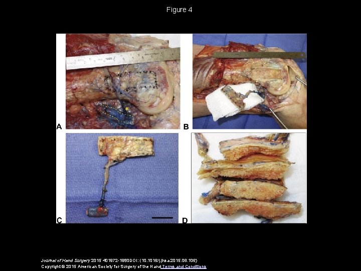 Figure 4 Journal of Hand Surgery 2015 401972 -1980 DOI: (10. 1016/j. jhsa. 2015.