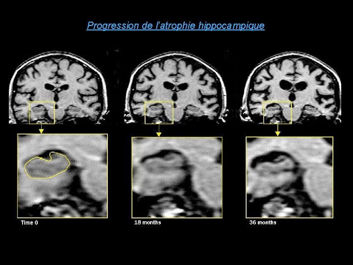 Progression de l’atrophie hippocampique 