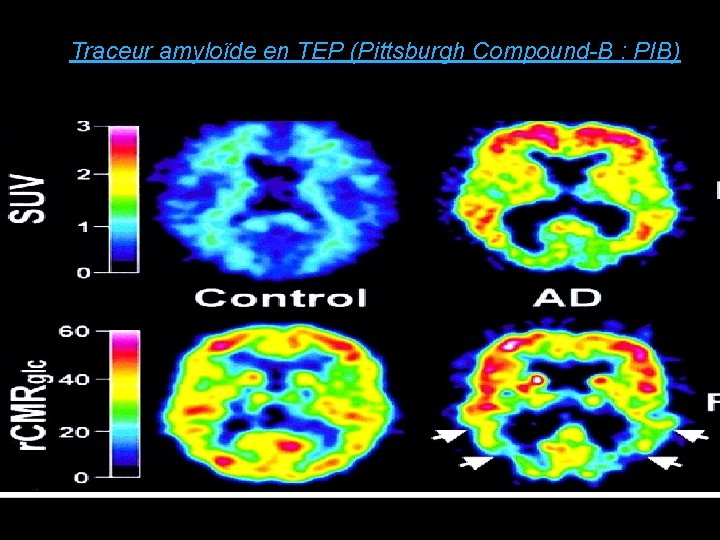 Traceur amyloïde en TEP (Pittsburgh Compound-B : PIB) 