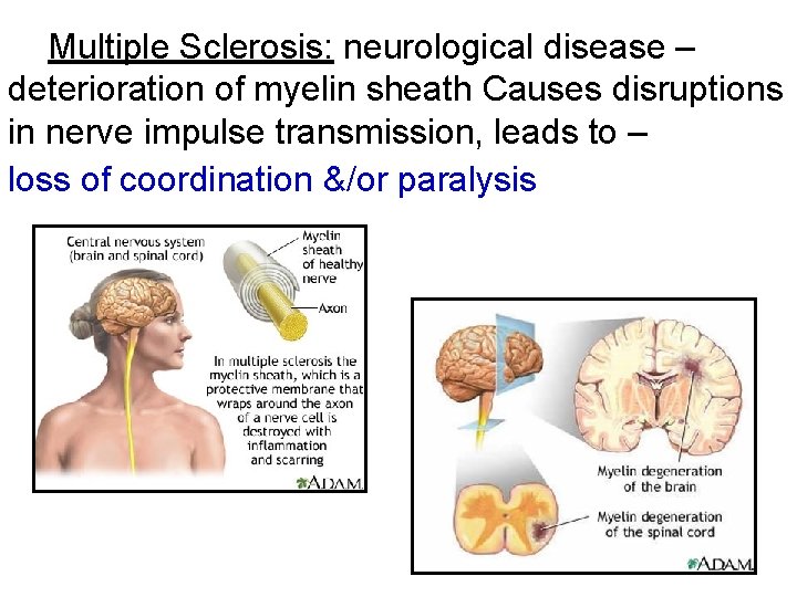 Multiple Sclerosis: neurological disease – deterioration of myelin sheath Causes disruptions in nerve impulse