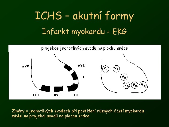 ICHS – akutní formy Infarkt myokardu - EKG projekce jednotlivých svodů na plochu srdce