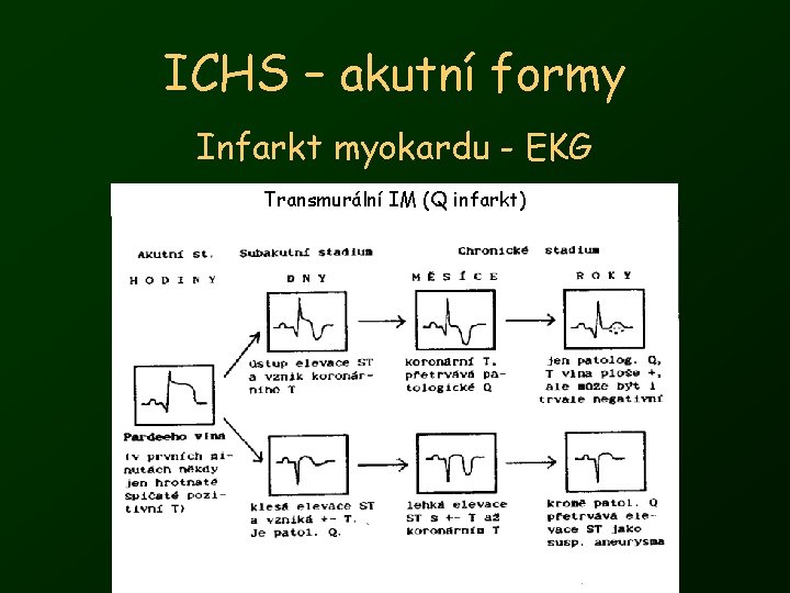 ICHS – akutní formy Infarkt myokardu - EKG Transmurální IM (Q infarkt) 