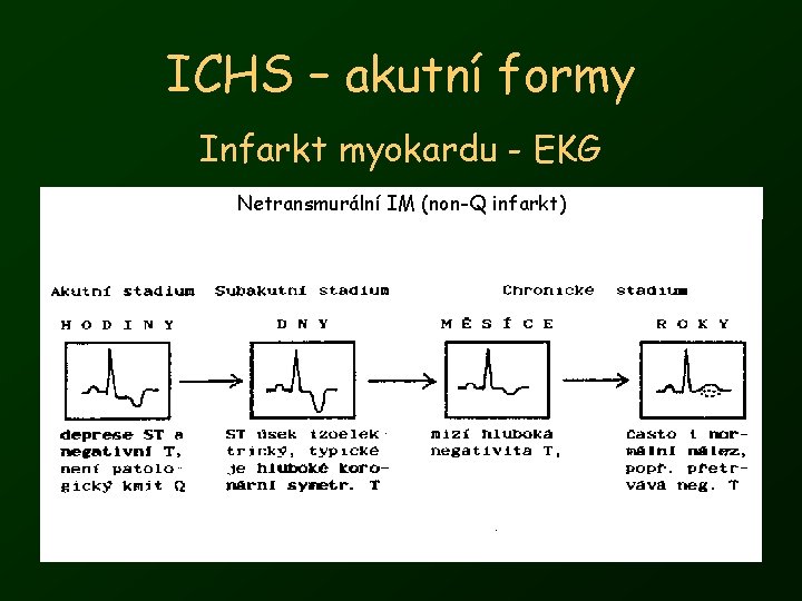 ICHS – akutní formy Infarkt myokardu - EKG Netransmurální IM (non-Q infarkt) 