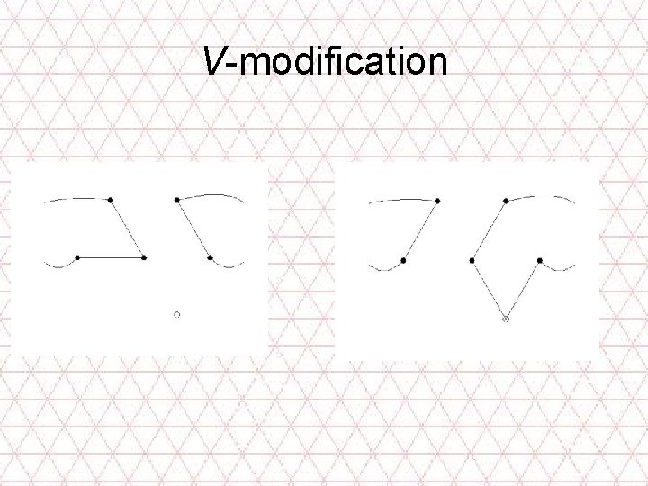 V-modification 