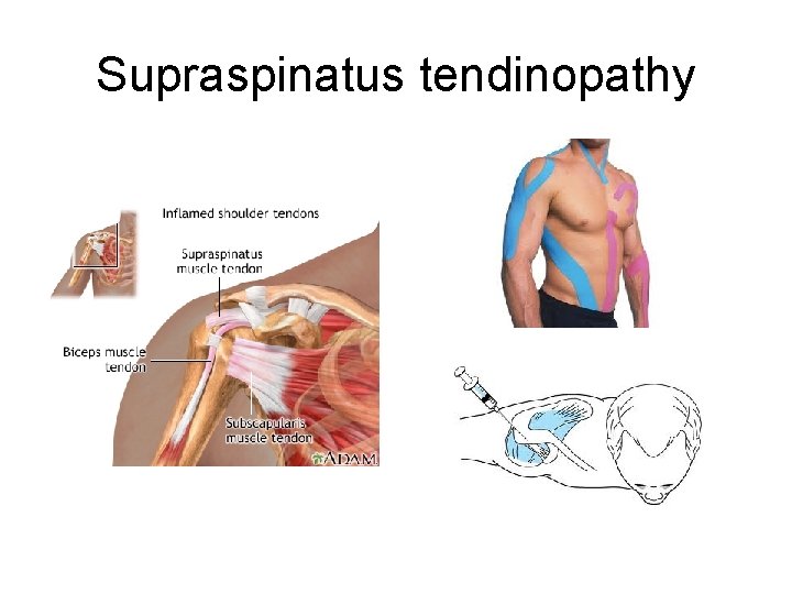 Supraspinatus tendinopathy 