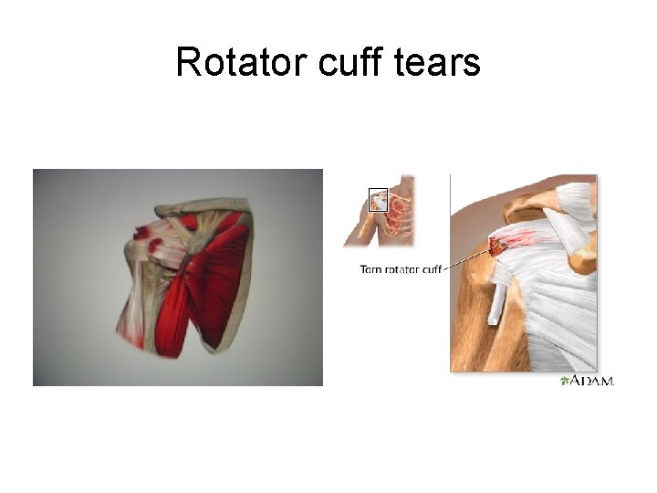 Rotator cuff tears 