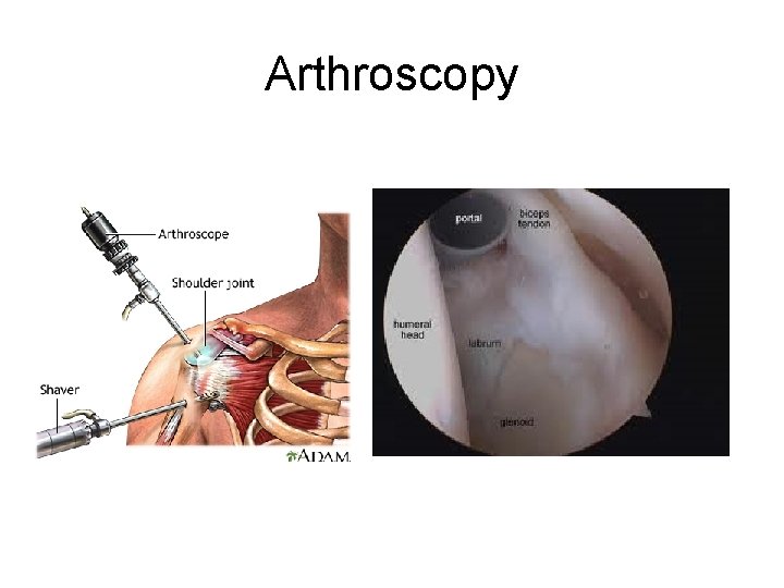 Arthroscopy 