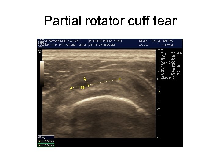 Partial rotator cuff tear 