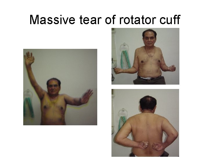 Massive tear of rotator cuff 