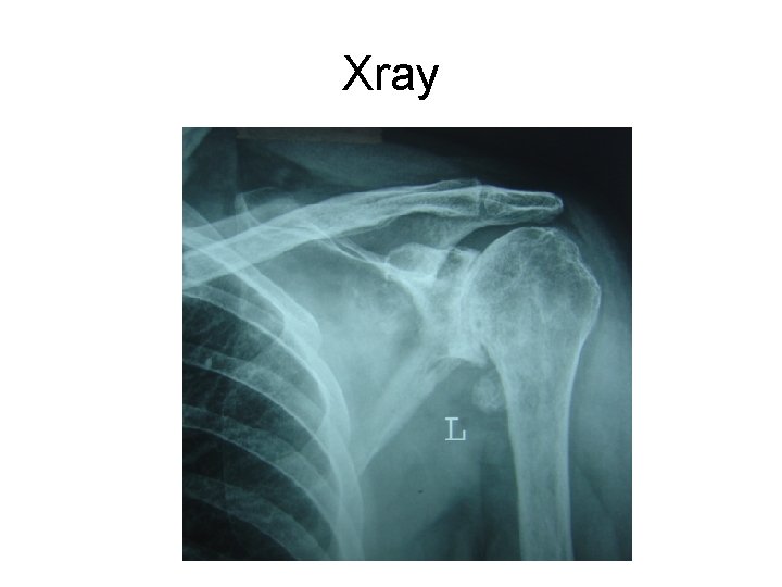 Xray 