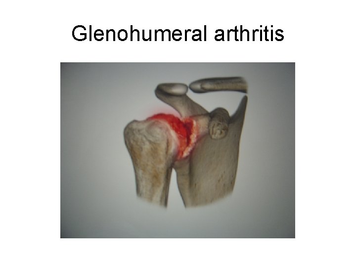 Glenohumeral arthritis 