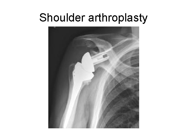 Shoulder arthroplasty 