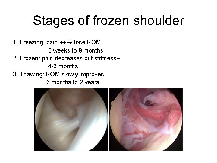 Stages of frozen shoulder 1. Freezing: pain ++ lose ROM 6 weeks to 9