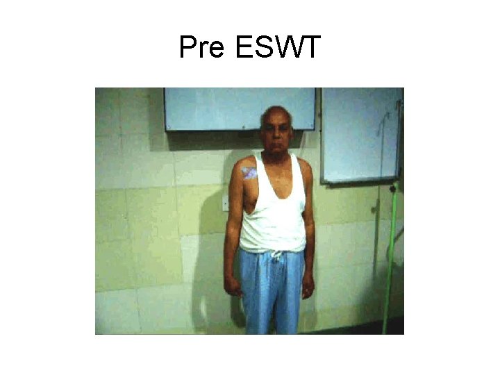 Pre ESWT 