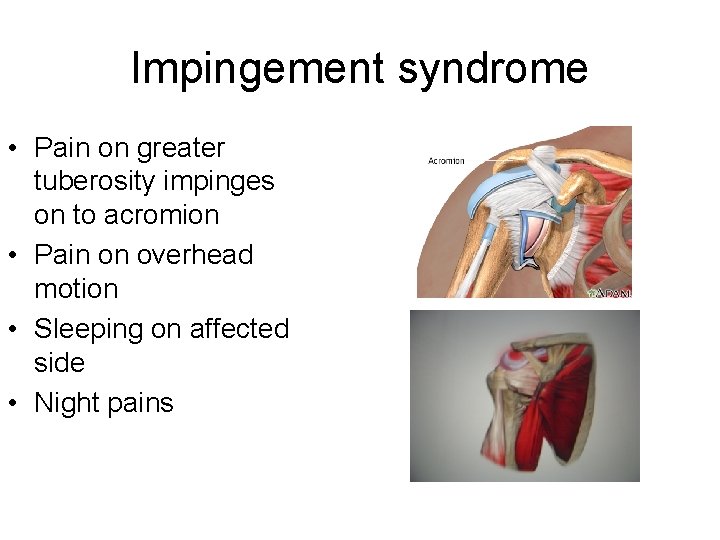 Impingement syndrome • Pain on greater tuberosity impinges on to acromion • Pain on