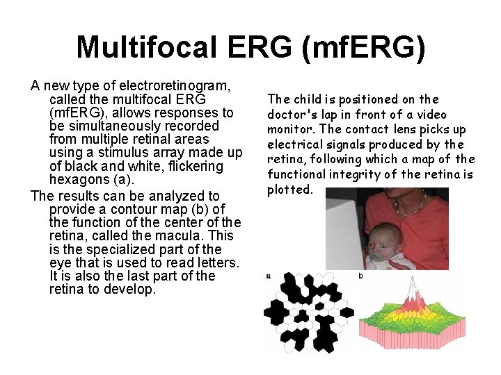 Multifocal ERG (mf. ERG) A new type of electroretinogram, called the multifocal ERG (mf. Multifocal ERG (mf. ERG) A new type of electroretinogram, called the multifocal ERG (mf.