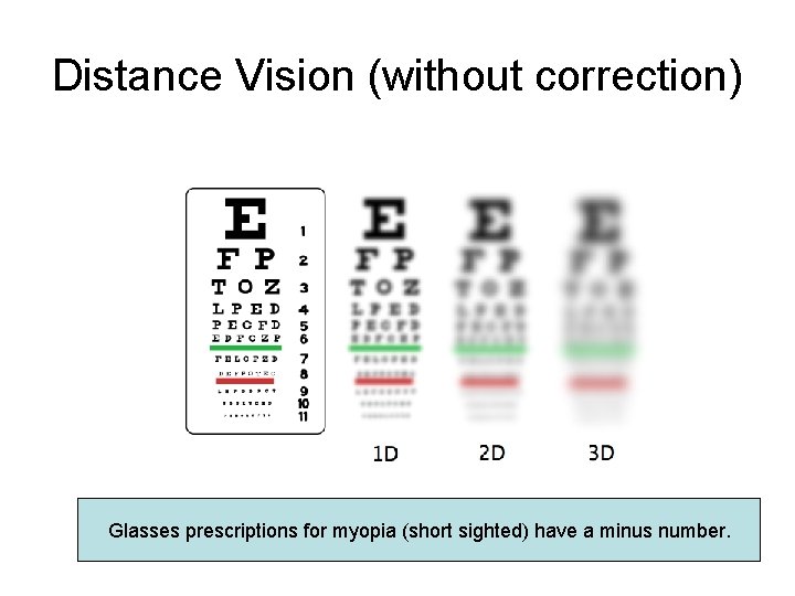 Distance Vision (without correction) Glasses prescriptions for myopia (short sighted) have a minus number. Distance Vision (without correction) Glasses prescriptions for myopia (short sighted) have a minus number.